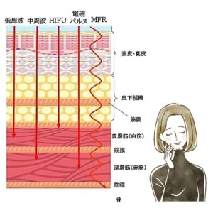 MFRという特殊波形